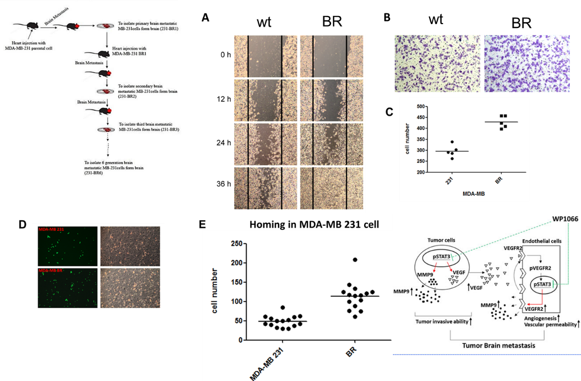 3. Breast cancer brain metastasis: