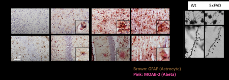 1. Amyloid beta (Aβ) deposition in Alzheimer’s disease (AD):